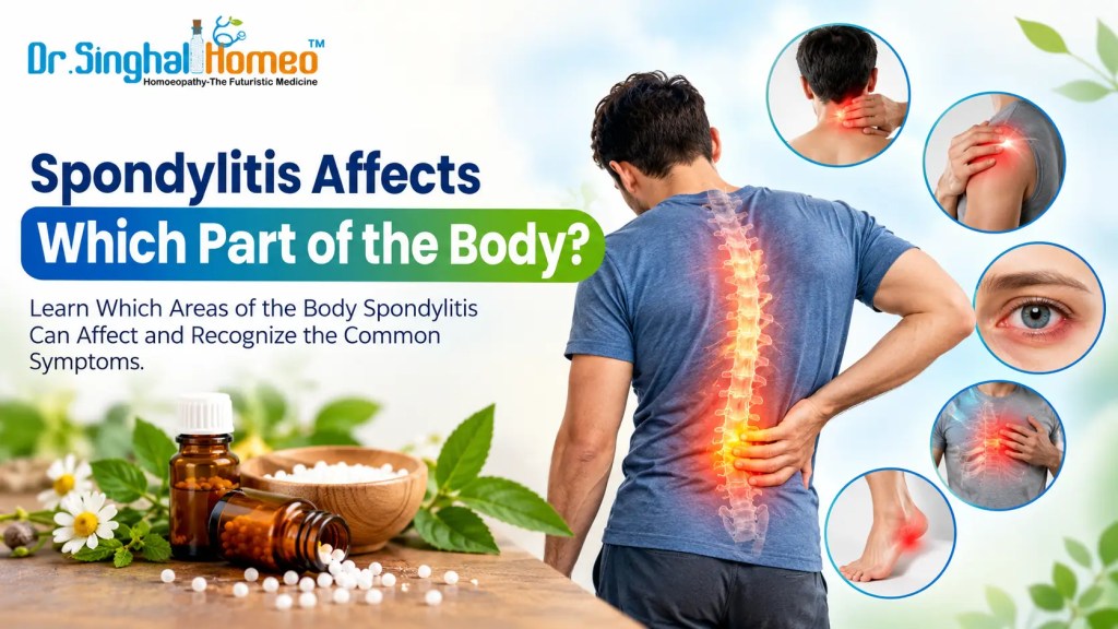 Spondylitis Body Areas and Symptoms